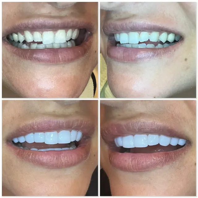 Clinical case photograph 11 from the ASDC smile gallery