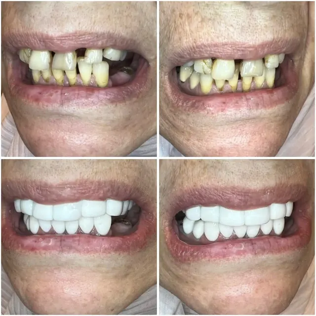 Clinical case photograph 4 from the ASDC smile gallery