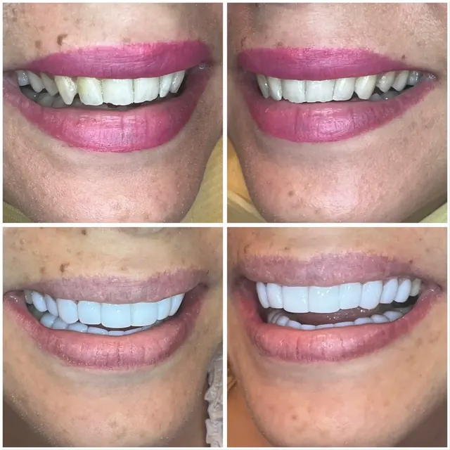 Clinical case photograph 8 from the ASDC smile gallery